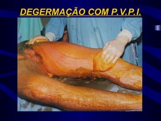 DEGERMAÇÃO COM P.V.P.I.
 