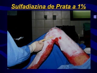 Sulfadiazina de Prata a 1%
 