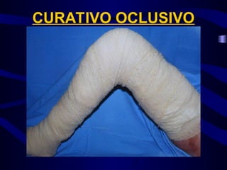CURATIVO OCLUSIVO
 