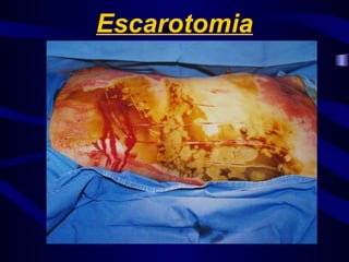 Escarotomia
 