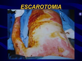 ESCAROTOMIA
 