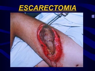 ESCARECTOMIA
 