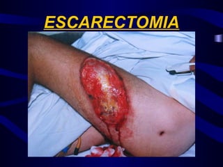 ESCARECTOMIA
 