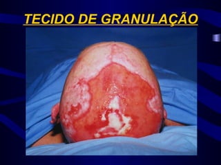 TECIDO DE GRANULAÇÃO
 