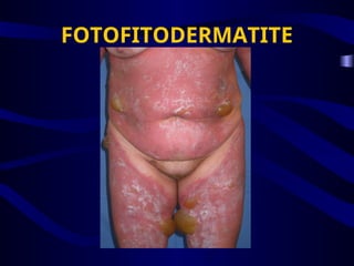 FOTOFITODERMATITE
 