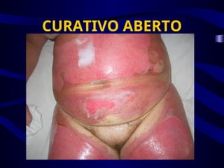 CURATIVO ABERTO
 