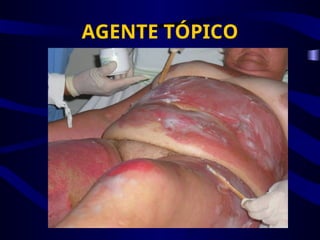 AGENTE TÓPICO
 