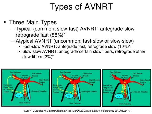 avnrt