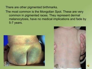 There are other pigmented birthmarks.
The most common is the Mongolian Spot. These are very
  common in pigmented races. They represent dermal
  melanocytosis, have no medical implications and fade by
  5-7 years.
 