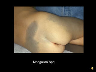 Mongolian Spot
 
