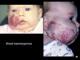 Mixed haemangiomas
 
