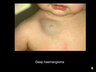 Deep haemangioma
 