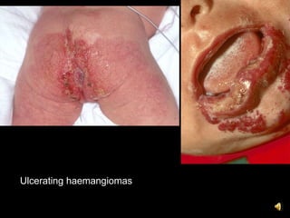 Ulcerating haemangiomas
 