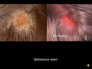 Sebaceous naevi
 