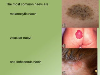 The most common naevi are

  melanocytic naevi




  vascular naevi




  and sebaceous naevi
 