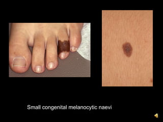 Small congenital melanocytic naevi
 