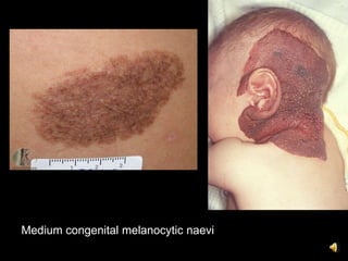 Medium congenital melanocytic naevi
 