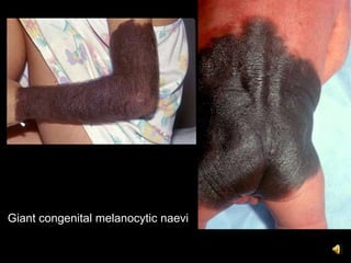Giant congenital melanocytic naevi
 