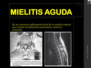 MIELITIS AGUDA
Es un trastorno inflamatorio focal de la médula espinal
que resulta en disfunción autonómica, motora y
sensorial.
JuanC.SalazarPajares
 