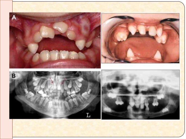 cleidocranial dysplasia