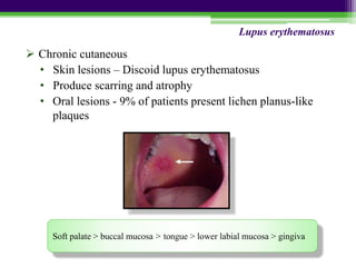  Chronic cutaneous
• Skin lesions – Discoid lupus erythematosus
• Produce scarring and atrophy
• Oral lesions - 9% of patients present lichen planus-like
plaques
Lupus erythematosus
Soft palate > buccal mucosa > tongue > lower labial mucosa > gingiva
 