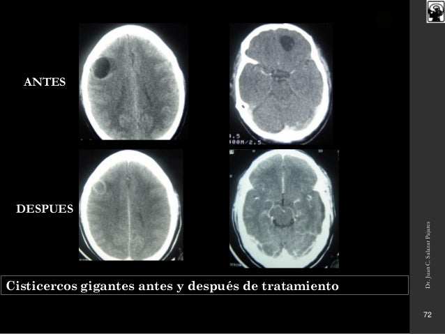 Resultado de imagen para neurocisticercosis ANTES Y DESPUES