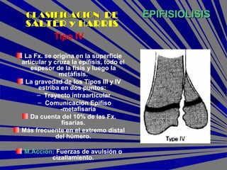 EPIFISIOLISISEPIFISIOLISIS
Tipo IV
La Fx. se origina en la superficie
articular y cruza la epífisis, todo el
espesor de la físis y luego la
metáfisis.
La gravedad de los Tipos III y IV
estriba en dos puntos:
– Trayecto intraarticular
– Comunicación Epifiso
-metafisaria
Da cuenta del 10% de las Fx.
fisarias.
Más frecuente en el extremo distal
del húmero.
M.Acción: Fuerzas de avulsión o
cizallamiento.
CLASIFICACIONCLASIFICACION DE
SALTER y HARRIS
 
