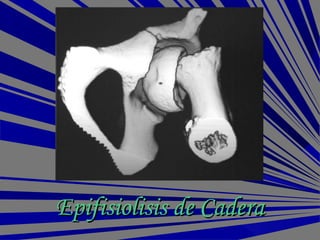 Epifisiolisis de CaderaEpifisiolisis de Cadera
 