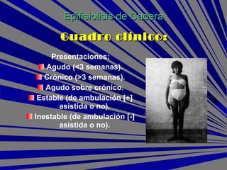 Presentaciones:
Agudo (<3 semanas).
Crónico (>3 semanas).
Agudo sobre crónico.
Estable (de ambulación [+]
asistida o no).
Inestable (de ambulación [-]
asistida o no).
Epifisiolisis de CaderaEpifisiolisis de Cadera
Cuadro clínico:Cuadro clínico:
 
