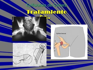 Epifisiolisis de CaderaEpifisiolisis de Cadera
TratamientoTratamiento
Qx.Qx.
 