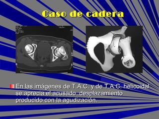 En las imágenes de T.A.C. y de T.A.C. helicoidalEn las imágenes de T.A.C. y de T.A.C. helicoidal
se aprecia el acusado desplazamientose aprecia el acusado desplazamiento
producido con la agudización.producido con la agudización.
Caso de caderaCaso de cadera
 
