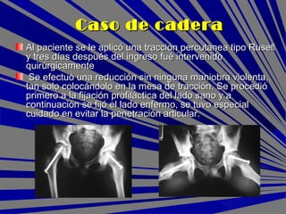 Al paciente se le aplicó una tracción percutanea tipo RusellAl paciente se le aplicó una tracción percutanea tipo Rusell
y tres días después del ingreso fué intervenidoy tres días después del ingreso fué intervenido
quirúrgicamentequirúrgicamente
Se efectuó una reducción sin ninguna maniobra violenta,Se efectuó una reducción sin ninguna maniobra violenta,
tan solo colocándolo en la mesa de tracción. Se procediótan solo colocándolo en la mesa de tracción. Se procedió
primero a la fijación profiláctica del lado sano y aprimero a la fijación profiláctica del lado sano y a
continuación se fijó el lado enfermo, se tuvo especialcontinuación se fijó el lado enfermo, se tuvo especial
cuidado en evitar la penetración articular.cuidado en evitar la penetración articular.
Caso de caderaCaso de cadera
 