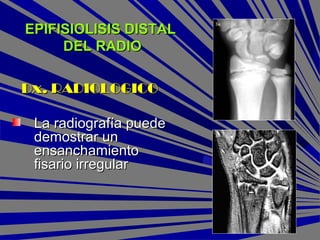 EPIFISIOLISIS DISTALEPIFISIOLISIS DISTAL
DEL RADIODEL RADIO
Dx. RADIOLOGICODx. RADIOLOGICO
La radiografía puedeLa radiografía puede
demostrar undemostrar un
ensanchamientoensanchamiento
fisario irregularfisario irregular
 