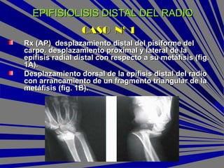 EPIFISIOLISIS DISTAL DEL RADIOEPIFISIOLISIS DISTAL DEL RADIO
Rx (AP) desplazamiento distal del pisiforme delRx (AP) desplazamiento distal del pisiforme del
carpo. desplazamiento proximal y lateral de lacarpo. desplazamiento proximal y lateral de la
epífisis radial distal con respecto a su metáfisis (fig.epífisis radial distal con respecto a su metáfisis (fig.
1A).1A).
Desplazamiento dorsal de la epífisis distal del radioDesplazamiento dorsal de la epífisis distal del radio
con arrancamiento de un fragmento triangular de lacon arrancamiento de un fragmento triangular de la
metáfisis (fig. 1B).metáfisis (fig. 1B).
CASO Nº 1CASO Nº 1
 