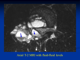 Axial T-2 MRI with fluid-fluid levels
 