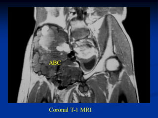 ABC




Coronal T-1 MRI
 