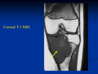 Coronal T-1 MRI
 