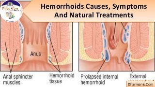 Hemorrhoids Causes, Symptoms
And Natural Treatments
Dharmanis.Com
 