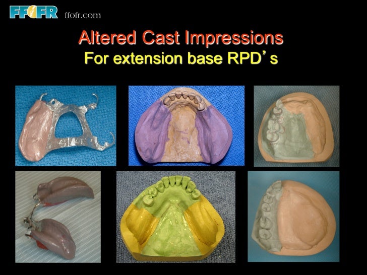9 impressions and physiologic adjustment altered cast technique