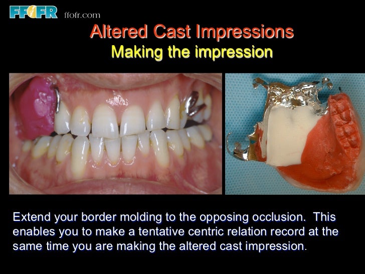 altered cast technique