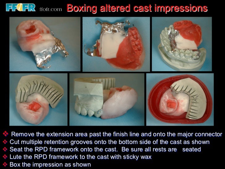 altered cast technique