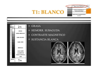 Pregrado – Dr Yee
T1: BLANCO
  GRASA
  HEMORR. SUBAGUDA
  CONTRASTE MAGNETICO
  SUSTANCIA BLANCA
 