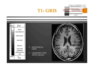 Pregrado – Dr Yee
T1: GRIS
  SUSTANCIA
GRIS
  LESIONES CON
AGUA (denso)
 