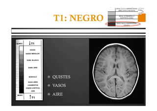 Pregrado – Dr Yee
T1: NEGRO
  QUISTES
  VASOS
  AIRE
 