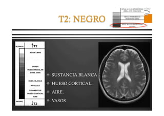 Pregrado – Dr Yee
T2: NEGRO
  SUSTANCIA BLANCA
  HUESO CORTICAL.
  AIRE.
  VASOS
 