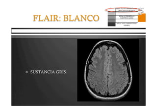 Pregrado – Dr Yee
FLAIR: BLANCO
  SUSTANCIA GRIS
 