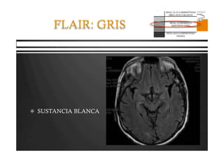 Pregrado – Dr Yee
FLAIR: GRIS
  SUSTANCIA BLANCA
 