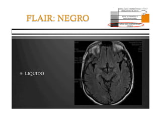 Pregrado – Dr Yee
FLAIR: NEGRO
  LIQUIDO
 