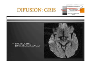 Pregrado – Dr Yee
DIFUSION: GRIS
  PARENQUIMA
(SUSTANCIA BLANCA)
 
