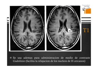 Pregrado – Dr Yee
T1
  Se usa ademas para administracion de medio de contraste
Gadolinio (facilita la relajacion de los nucleos de H cercanos)
 
